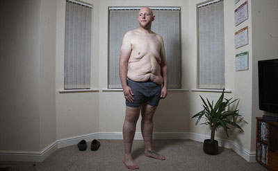 英国近三分之二减肥成功挂在腹部松弛皮肤